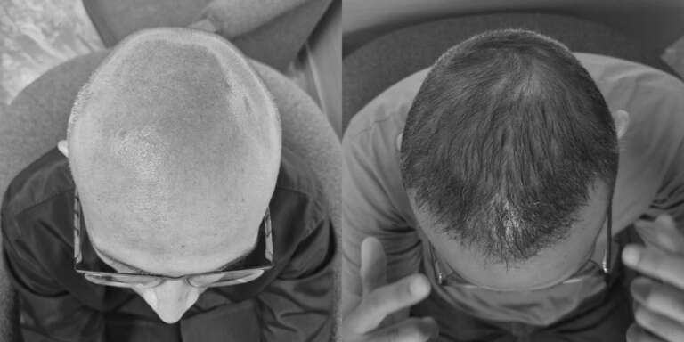 black white test micripel antes y depues